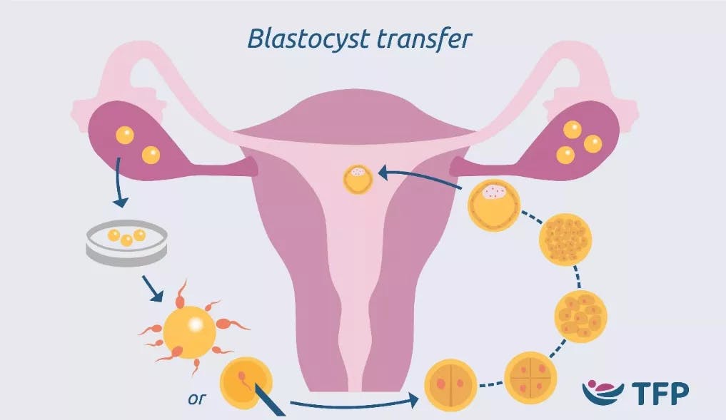 blastocyst transfer infographic