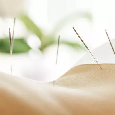 Additional Treatments Acupuncture