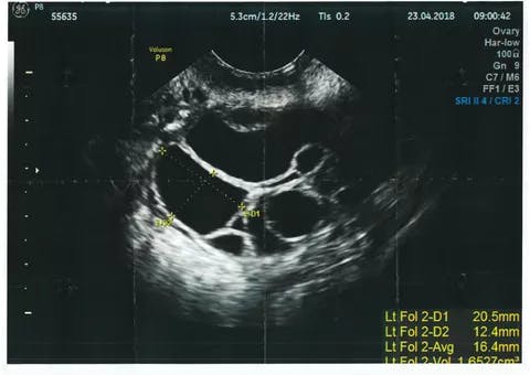 An ultrasound