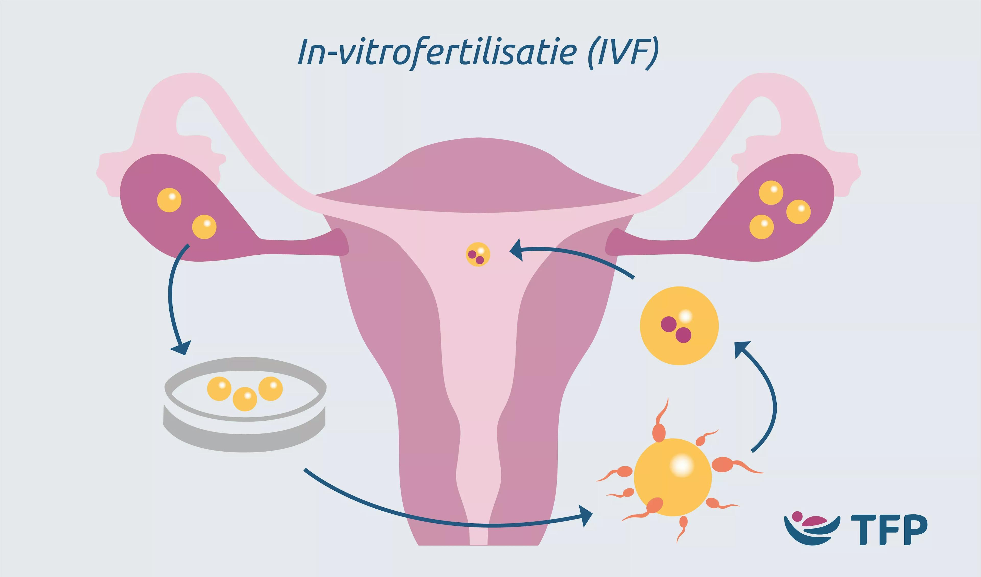 IVF image uterus dutch