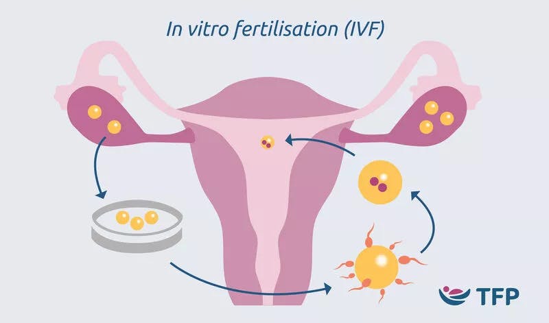 In vitro fertilisation (IVF) infographic showing treatment stages in and around the uterus